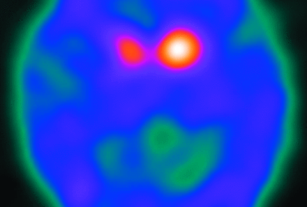 Fig 11.